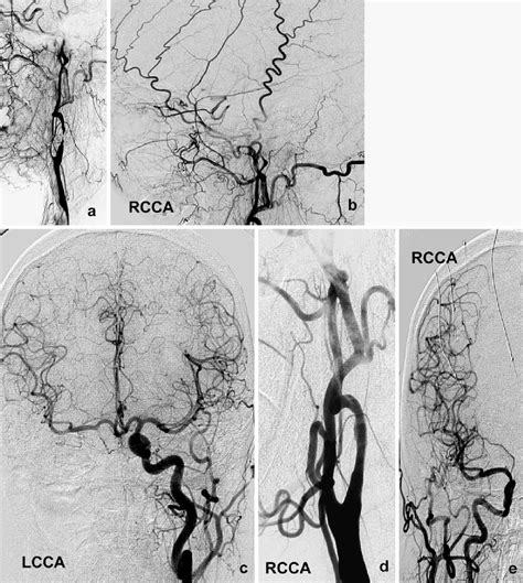 Internal Carotid Artery Stenting In Patients With Symptomatic Atheromatous Pseudo Occlusion