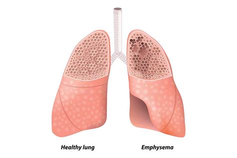 The Difference Between Copd And Emphysema Kelsey Seybold Clinic