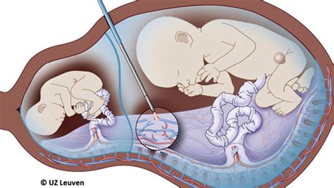 Best Fetal Therapy In Surat