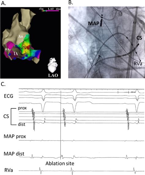 E Three Dimensional Electroanatomic Map A And Fluoroscopic Picture