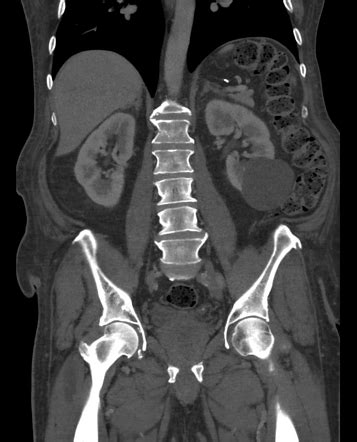 Simple renal cyst | Radiology Case | Radiopaedia.org