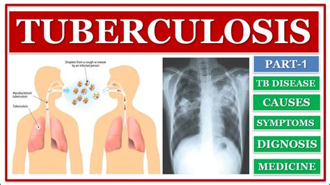 Tuberculosis Tb Disease Part 1 Tb Disease Causes Sign And Symptoms 🌡️ Basic