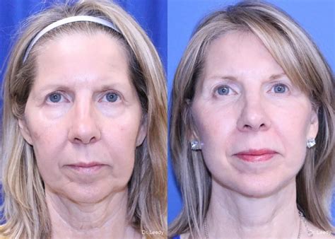 Fat Grafting Face Before And After Gallery