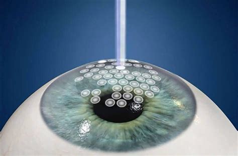 LASIK Center In Boston MA Laser Vision Correction Boston Laser