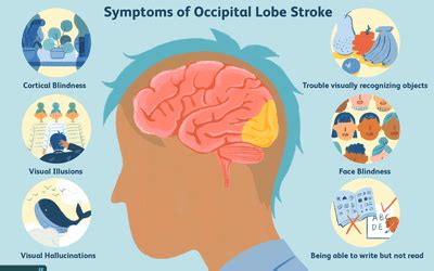 Flashing Lights In Eyes After Stroke Americanwarmoms Org