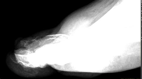 Gas Gangrene Diabetic Foot Treatment at Jean Carothers blog