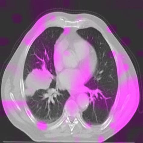 Lung Cancer NormAug Training Instance Segmentation Dataset V1 2023 07