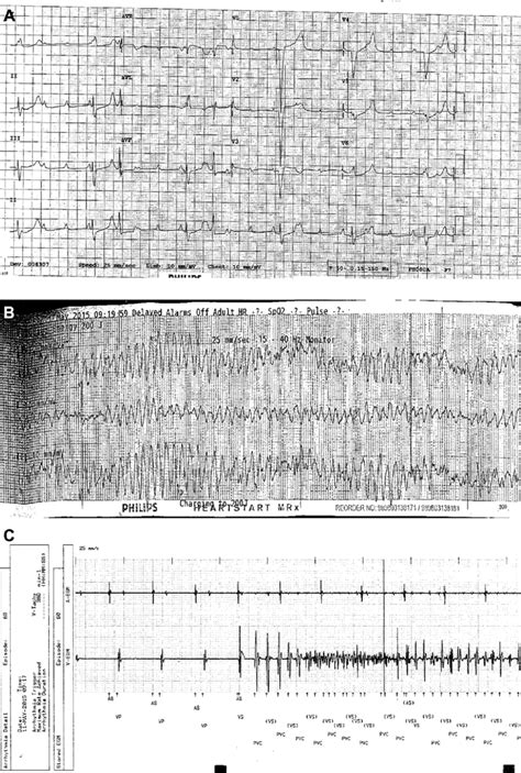 A Twelve Lead Electrocardiogram Showing Complete Atrioventricular