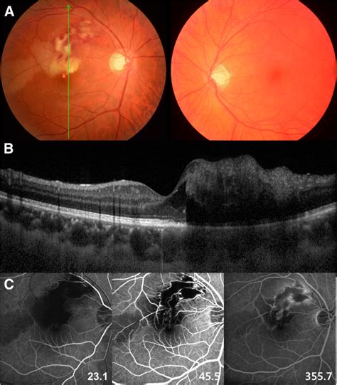 A Novel Pax3 Mutation In A Korean Patient With Waardenburg Syndrome Type 1 And Unilateral Branch