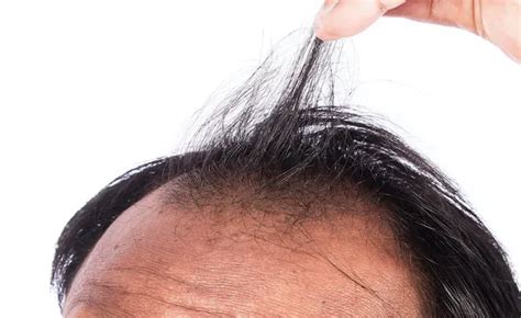 Everything You Need To Know About Hair Thinning