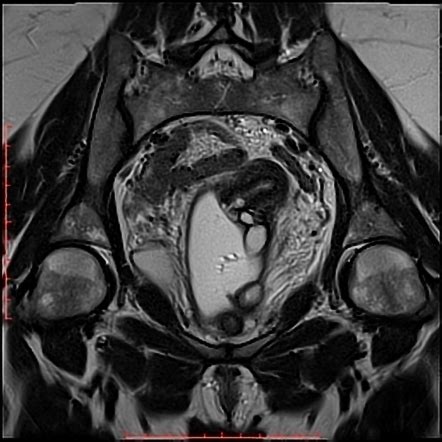 Gartner Duct Cyst And Bartholin Gland Cyst Image Radiopaedia Org