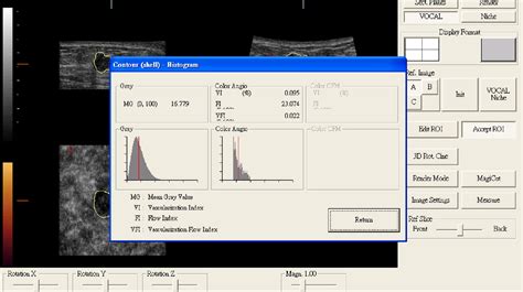 Characterization Of Benign And Malignant Solid Breast Masses In