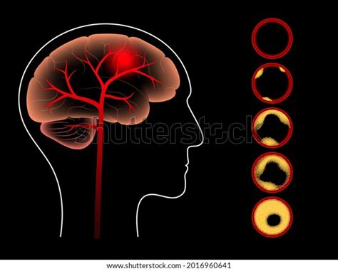 Ischemic Brain Stroke Arteriosclerosis Human Head Stock Vector Royalty