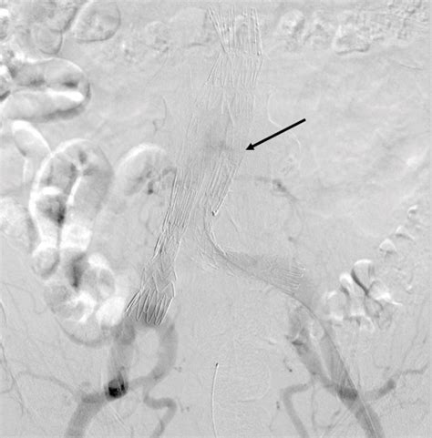 Type Ii Endoleak Iliolumbar Access A Surgeons Notes