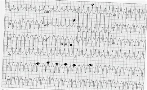 Emergency Medicine Educationecg Pointers Ventricular