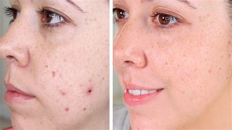 Cicatrizes De Acne Tipos De Marcas Manchas E Como As 50 OFF