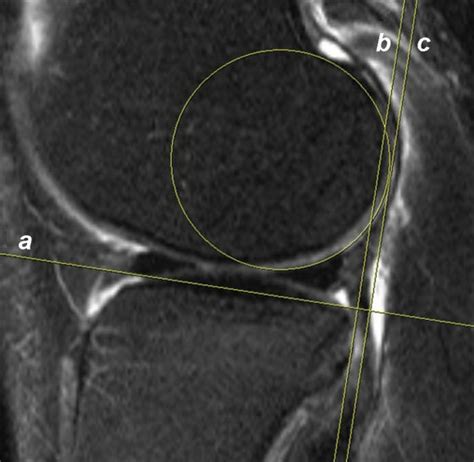 Measurement Technique Of Anterior Tibial Translation First A Best Fit