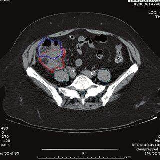 A Computed Tomography Ct Scan With An Intra Abdominal Mass