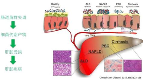 非酒精性脂肪性肝病（nafld）治疗的新靶点