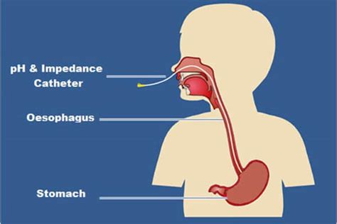 Esophageal Ph Monitoring | Hot Sex Picture