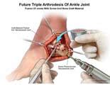 Amicus Illustration Of Amicus Surgery Ankle Joints Future Triple