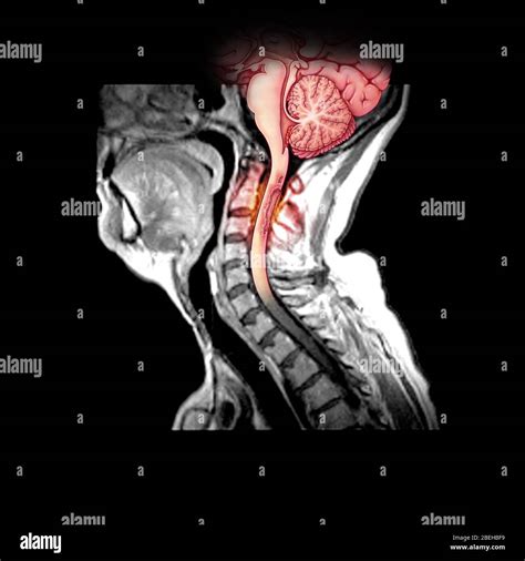 Demyelination Of Spinal Cord In Ms Stock Photo Alamy