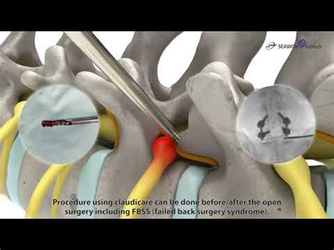 Claudicare Percutaneous Neurolysis And Foraminoplasty By Seawon