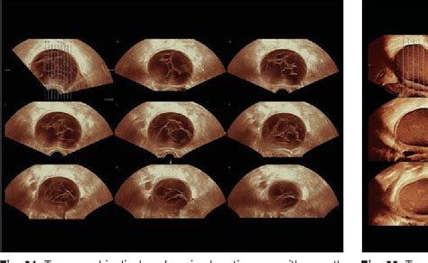 Figure 21 From Current Role Of 3D 4D Sonography In Obstetrics And