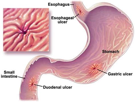 Peptic Ulcers Physiopedia