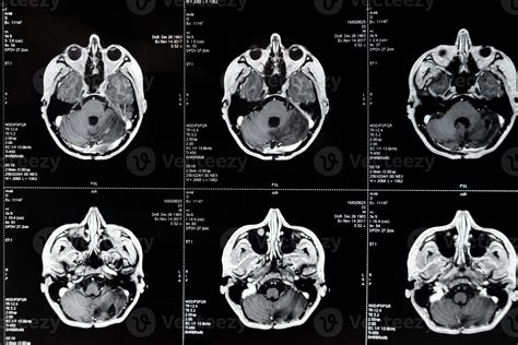 Ressonância Magnética Com Tumor Cerebral Imagem De Ressonância Magnética 18963517 Foto De