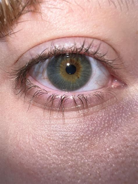 Do I Have Central Heterochromia Reyes