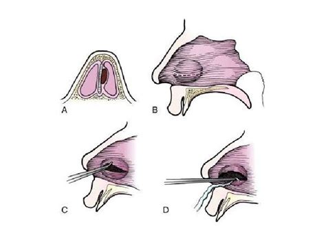 Clinical Procedures Septalauricular Hematoma