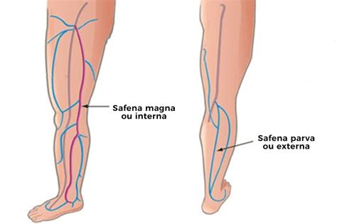 Tratamento De Veia Safena Laser