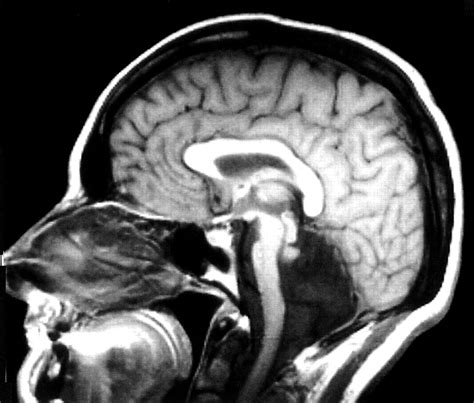 Arnold Chiari Malformation Mri Images