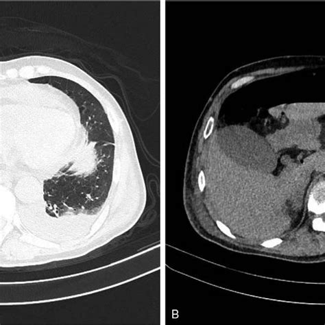 Abdominal Computed Tomography Scans Free Intraperitoneal Gas Is Seen