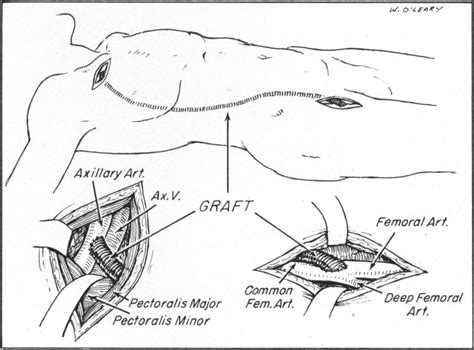 Oxford Vascular Surgery Oxfordvascular Twitter