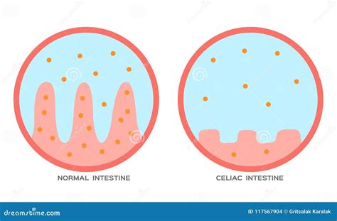 Celiac Disease Cartoon Vector CartoonDealer 41443277