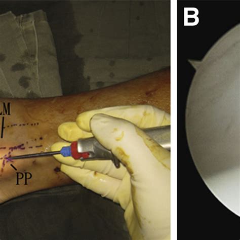 Endoscopic reconstruction of the left superior peroneal retinaculum ...