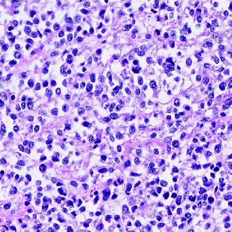 Histology Of The Tumor Showing Round Ovoid To Spindle Cells With