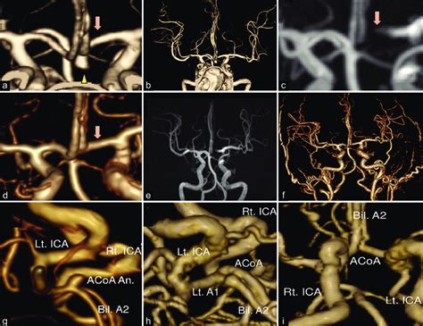 E Preoperative Computed Tomography Angiography Cta Revealed The 4 0