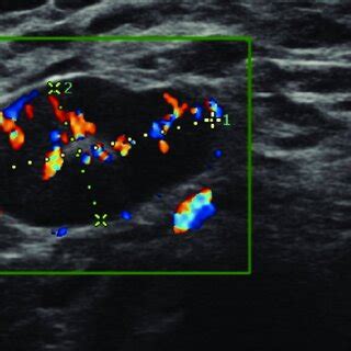 Ultrasound Of An Axillary Lymph Node With Diffuse Cortex Thickening And