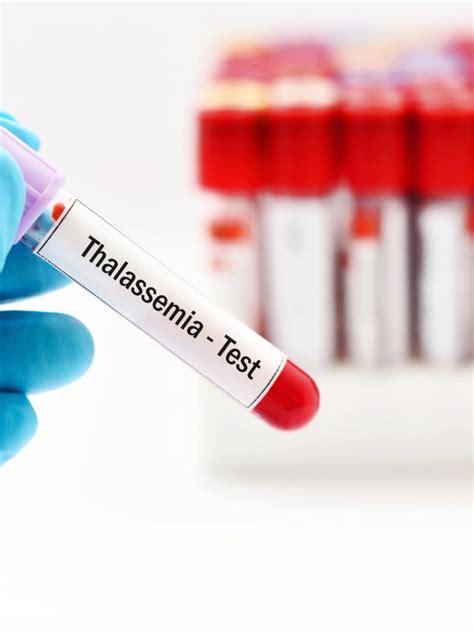 What is Thalassemia? | The Indian Express