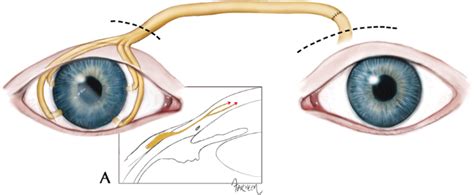 Anatomic Characteristics Of Supraorbital And Supratrochlear Nerves