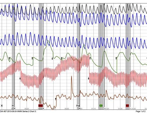 Understanding The Polygraph Chart A Deep Dive Into Lie Detection Lie