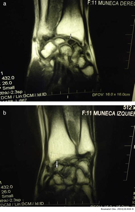 Bilateral Avascular Necrosis Of The Scaphoid Preiser Disease A Rare