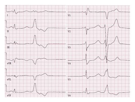 Ventricular Extrasystole In A 12 Lead Ecg Originating From The Right