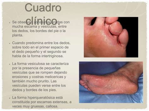 Micosis Superficiales Y Candidiasis