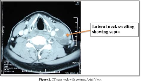 Figure From Metastatic Papillary Thyroid Carcinoma Presenting As