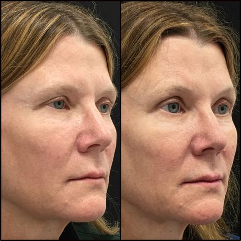 Brow Lift Before After Photos Flora Levin Md