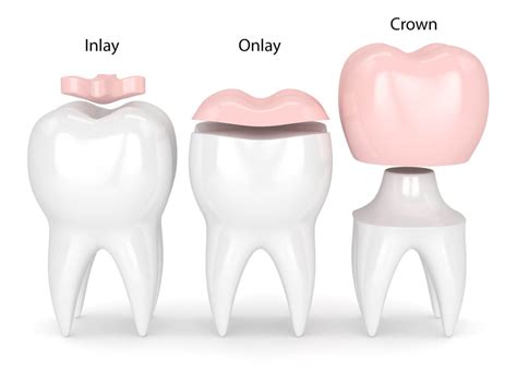 Crowns Inlay Onlays Peachcroft Dental Surgery